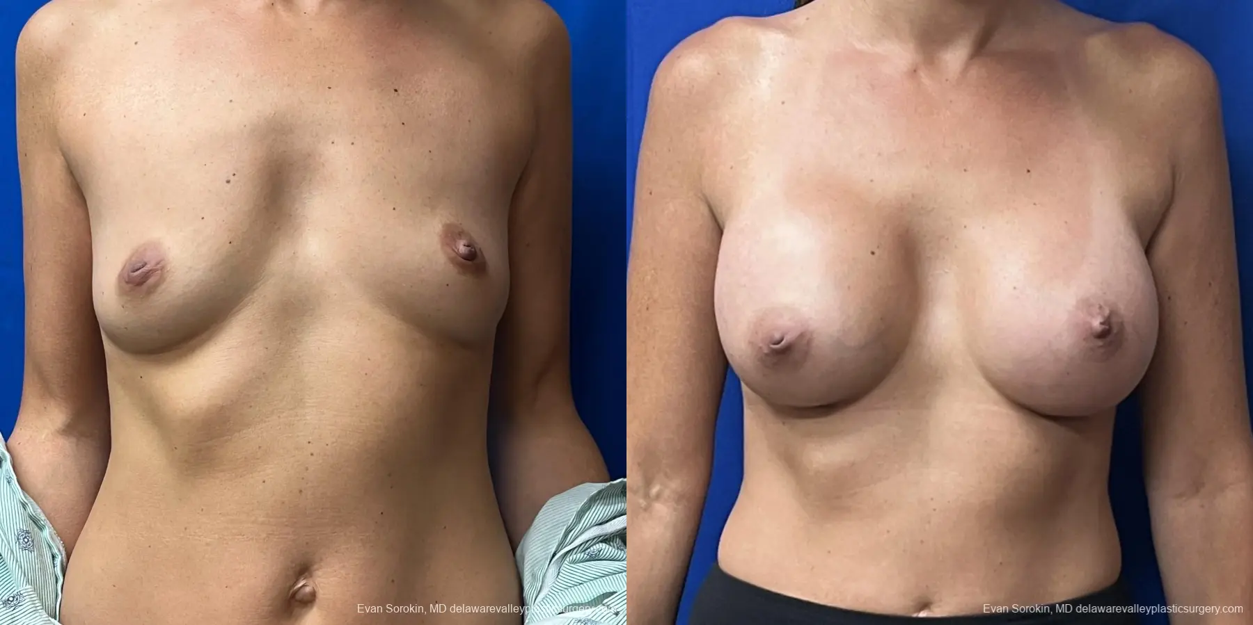 Breast Augmentation: Patient 198 - Before and After 1