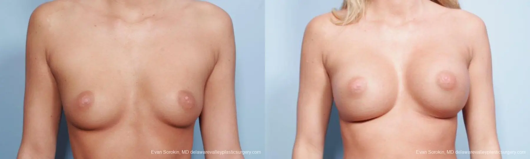 Philadelphia Breast Augmentation 9177 - Before and After 1