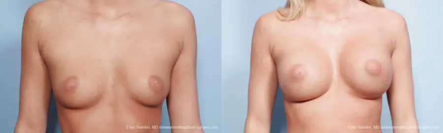 Philadelphia Breast Augmentation 9177 - Before and After 1