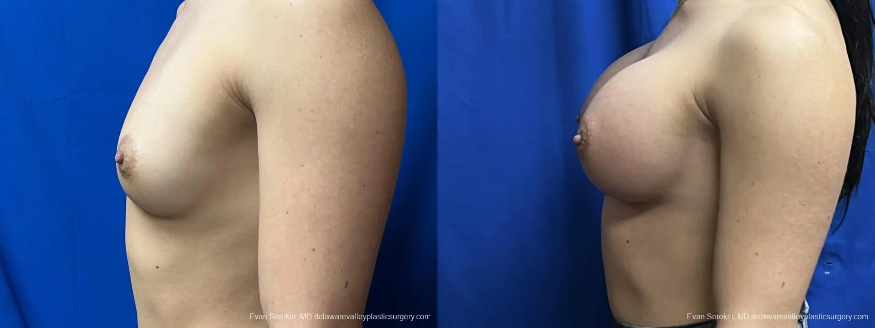 Breast Augmentation: Patient 235 - Before and After 5