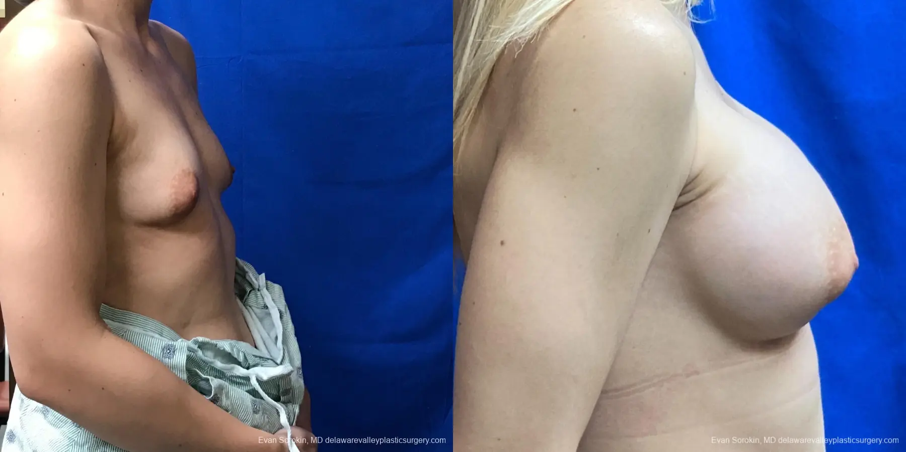 Breast Augmentation: Patient 192 - Before and After 3