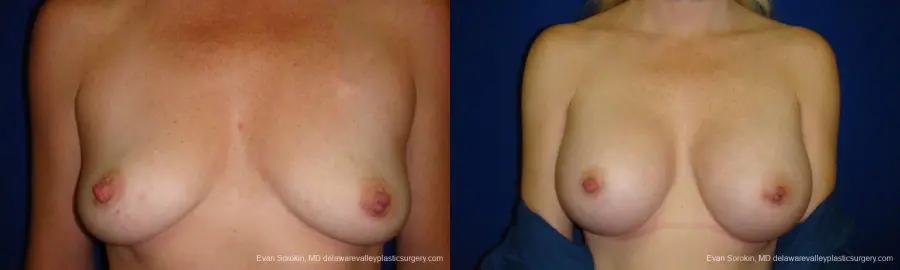Philadelphia Breast Augmentation 9295 - Before and After 1