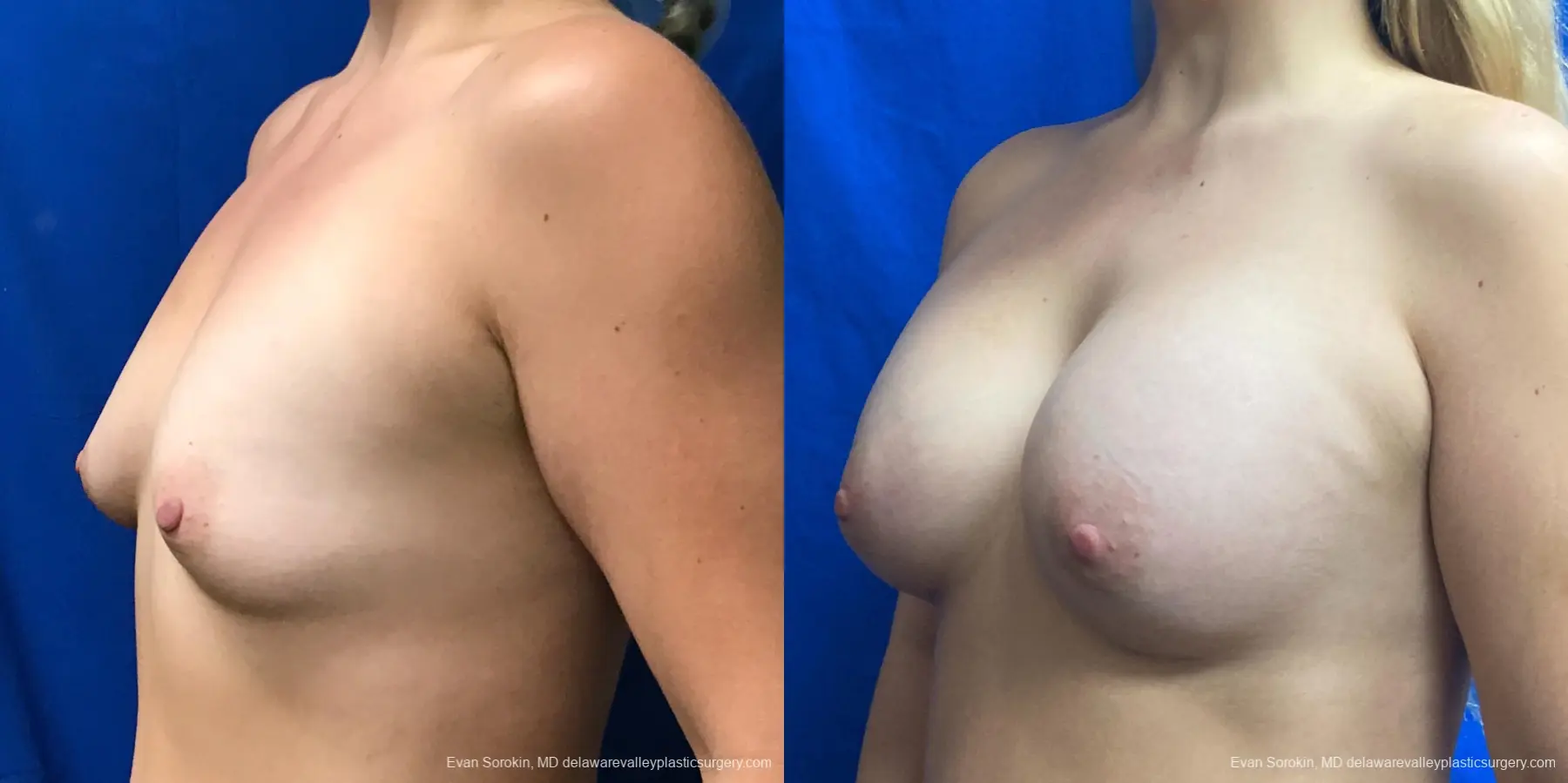 Breast Augmentation: Patient 190 - Before and After 4