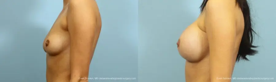 Philadelphia Breast Augmentation 9195 - Before and After 5