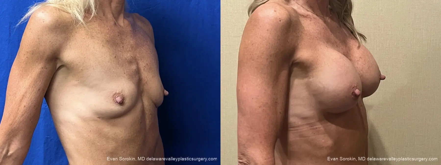 Breast Augmentation: Patient 319 - Before and After 2