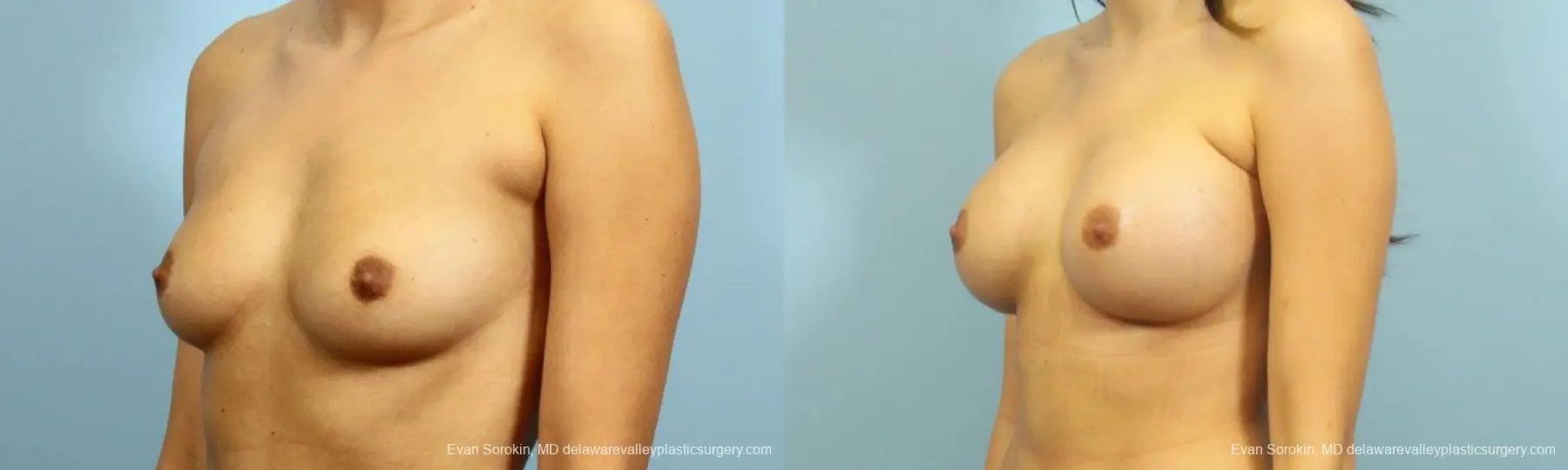 Philadelphia Breast Augmentation 9195 - Before and After 4