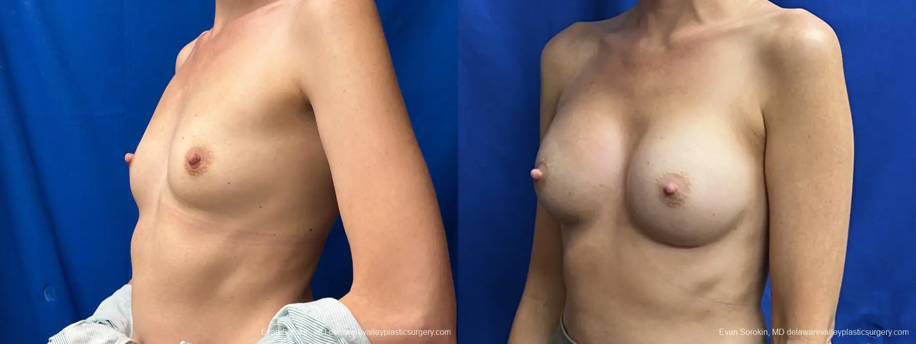 Breast Augmentation: Patient 203 - Before and After 4