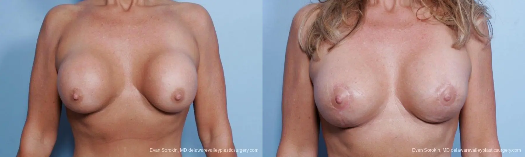 Philadelphia Breast Augmentation 9452 - Before and After 1