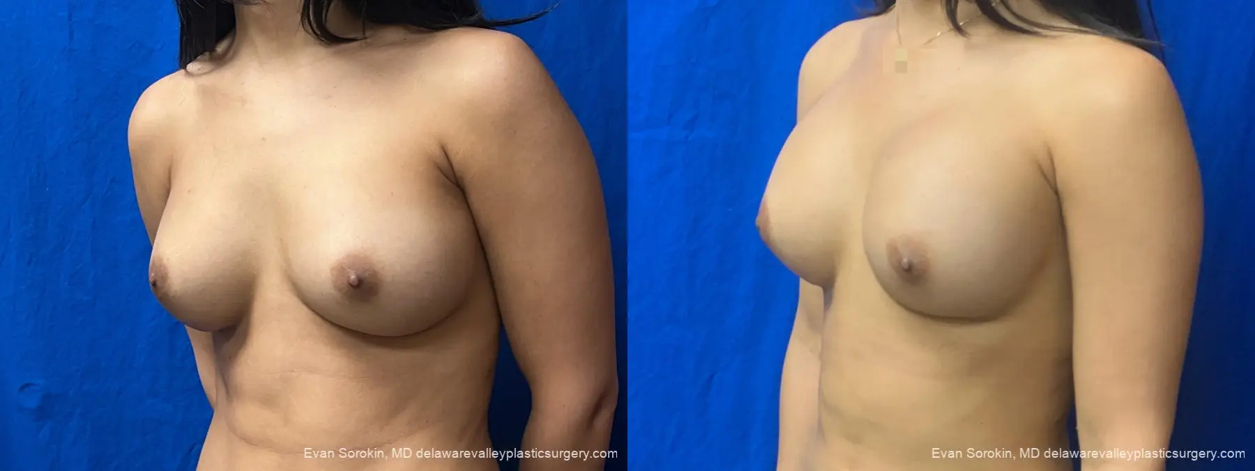 Breast Augmentation: Patient 322 - Before and After 3