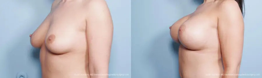 Philadelphia Breast Augmentation 9172 - Before and After 4