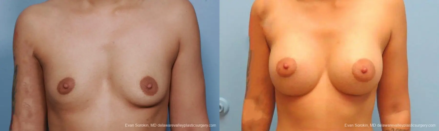 Philadelphia Breast Augmentation 9382 - Before and After 1