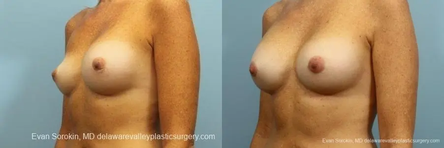 Philadelphia Breast Augmentation 8654 - Before and After 3