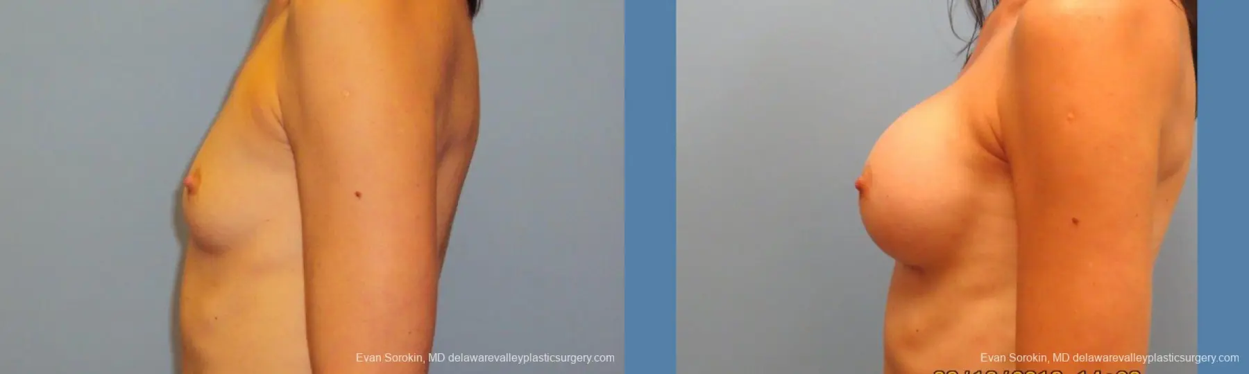 Philadelphia Breast Augmentation 9417 - Before and After 5