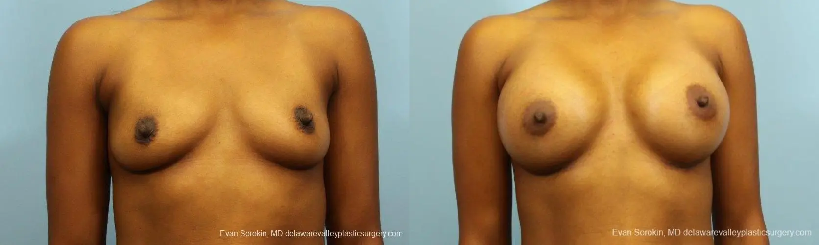 Philadelphia Breast Augmentation 8768 - Before and After 1