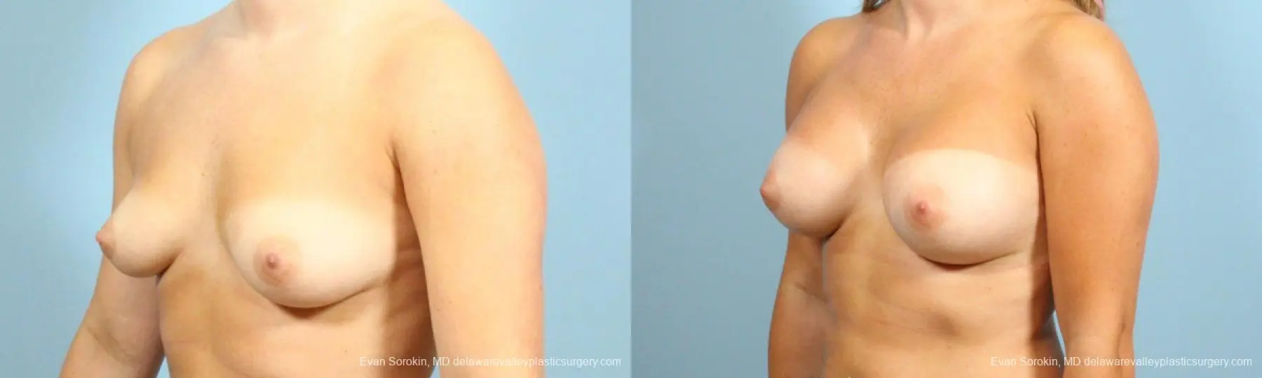 Philadelphia Breast Augmentation 8650 - Before and After 3