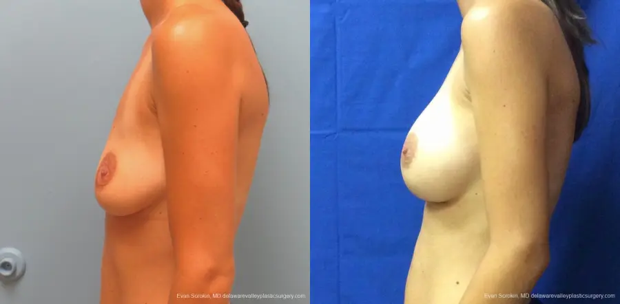 Philadelphia Breast Augmentation 13067 - Before and After 5