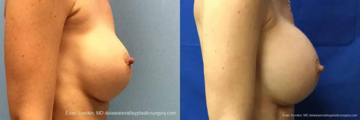 Philadelphia Breast Augmentation 10815 - Before and After 3