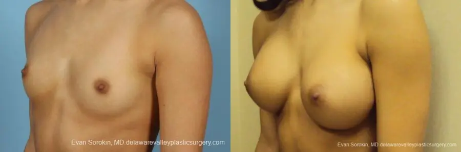 Philadelphia Breast Augmentation 9408 - Before and After 4