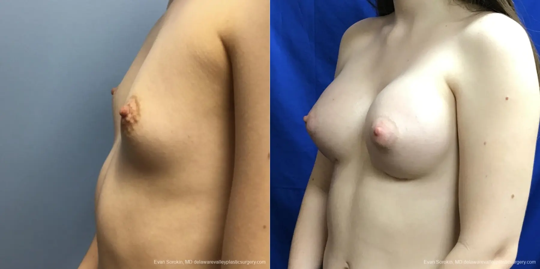 Breast Augmentation: Patient 195 - Before and After 3