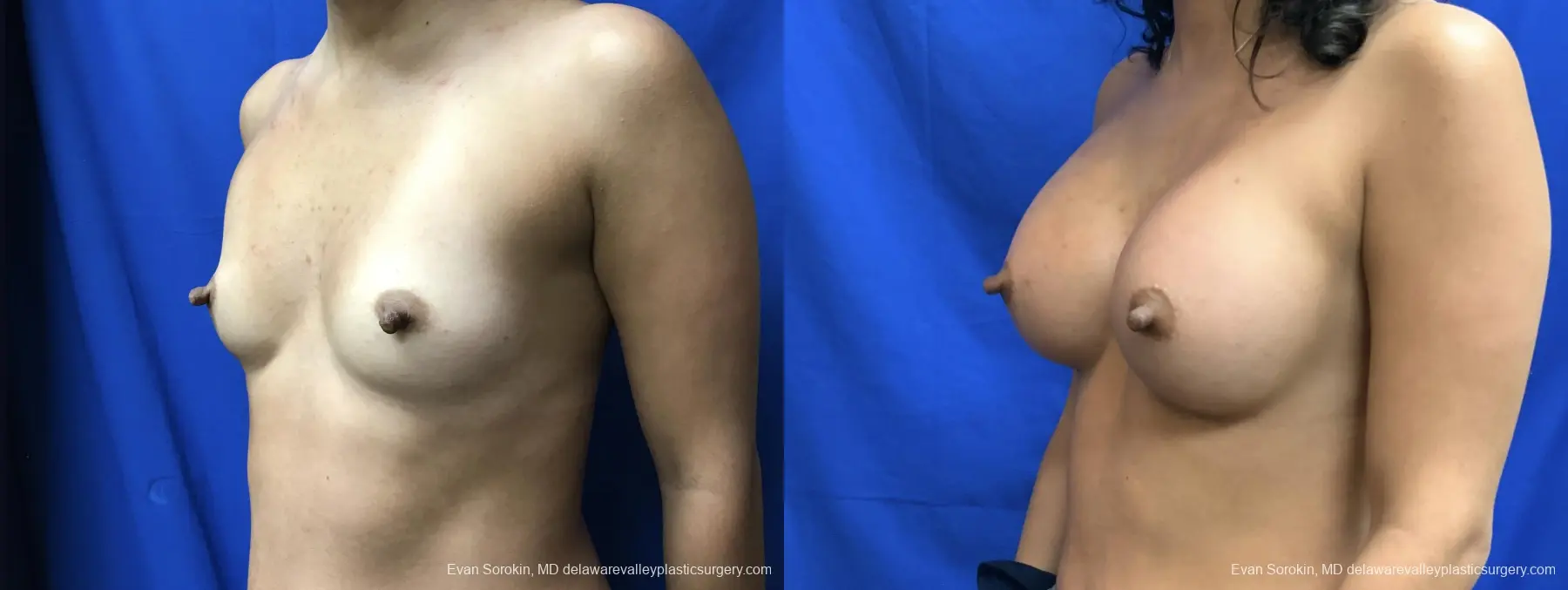 Breast Augmentation: Patient 210 - Before and After 4