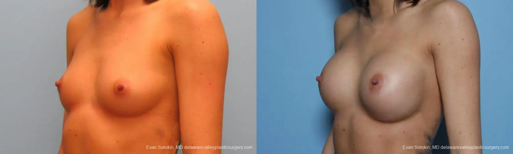 Philadelphia Breast Augmentation 9421 - Before and After 4
