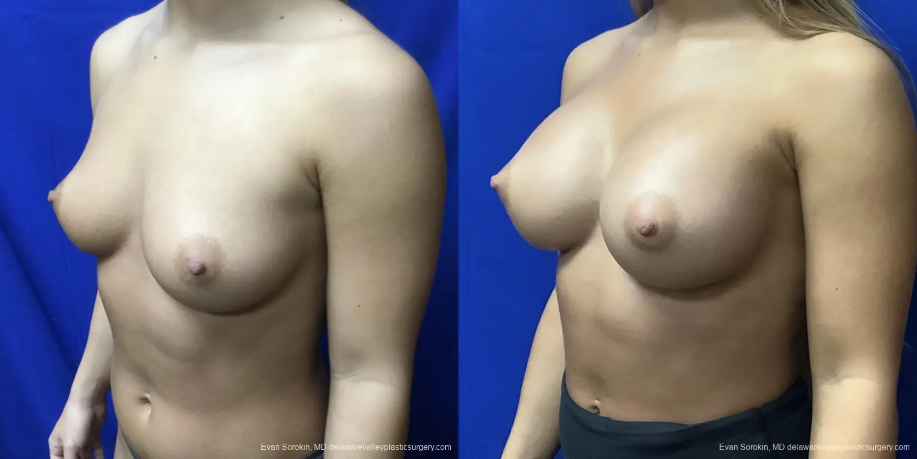Breast Augmentation: Patient 193 - Before and After 4