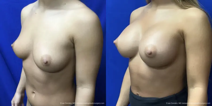 Breast Augmentation: Patient 167 - Before and After 4