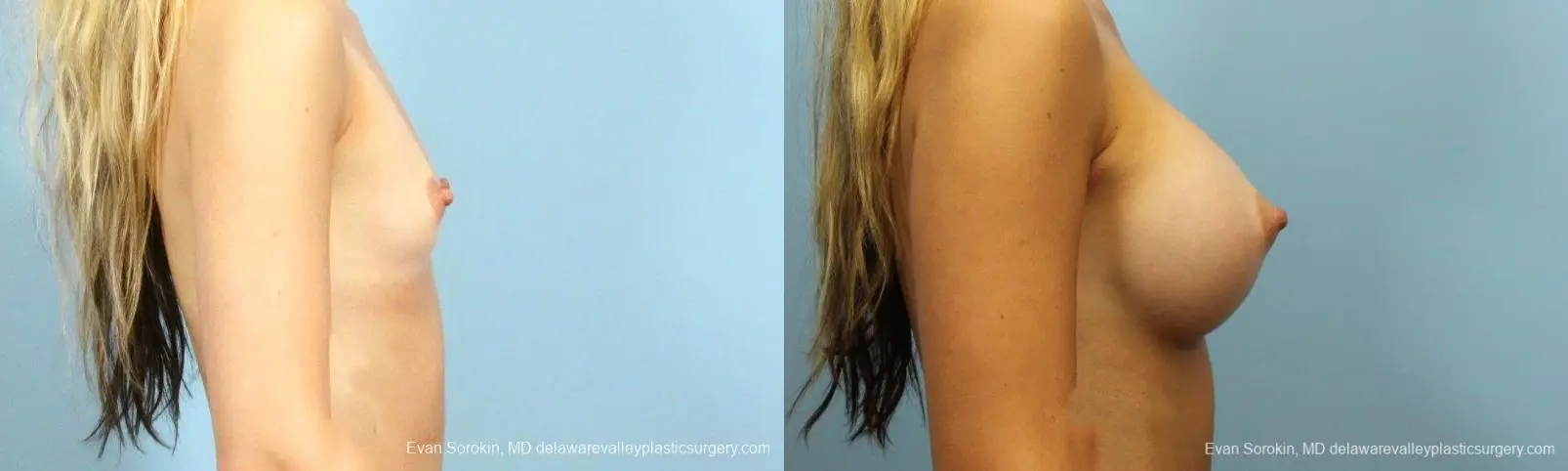 Philadelphia Breast Augmentation 9409 - Before and After 3