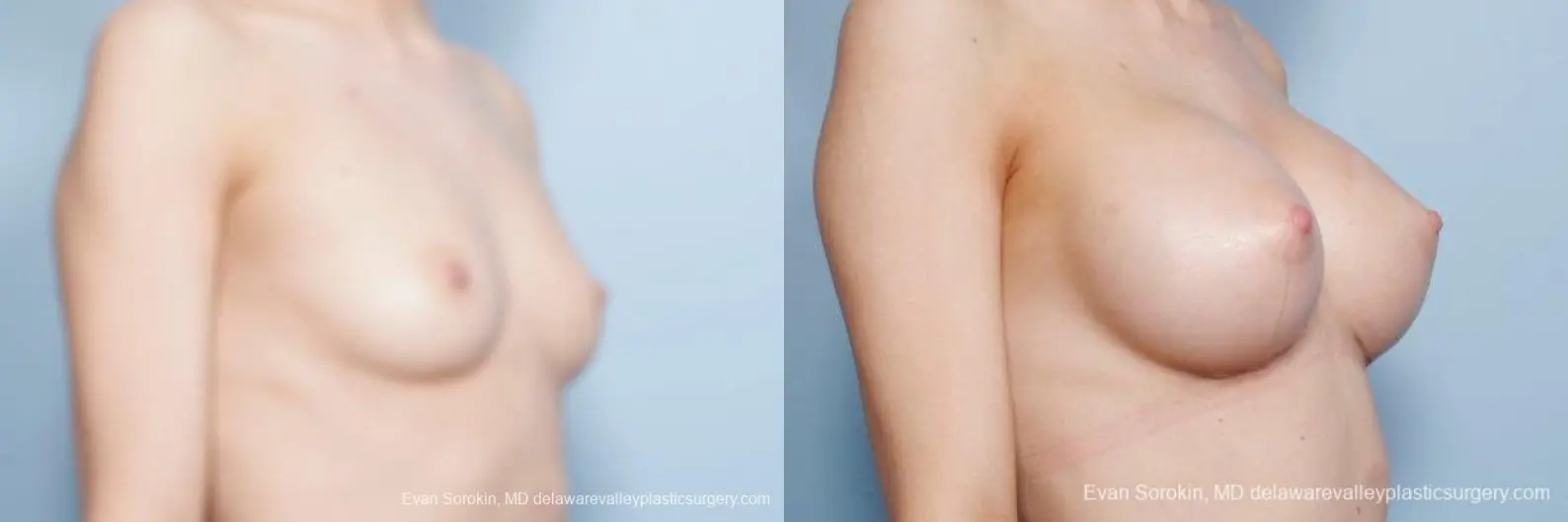 Philadelphia Breast Augmentation 8663 - Before and After 2