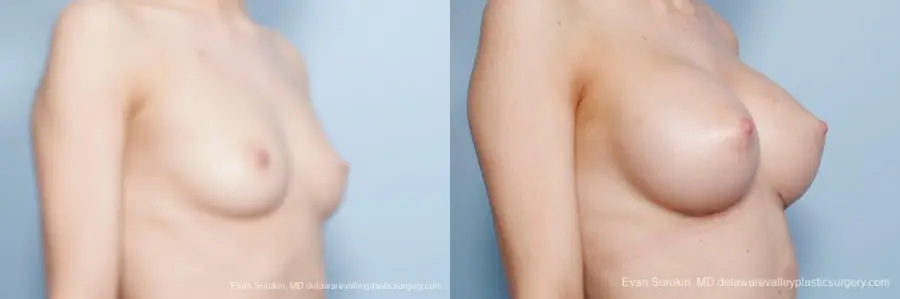 Philadelphia Breast Augmentation 8663 - Before and After 2