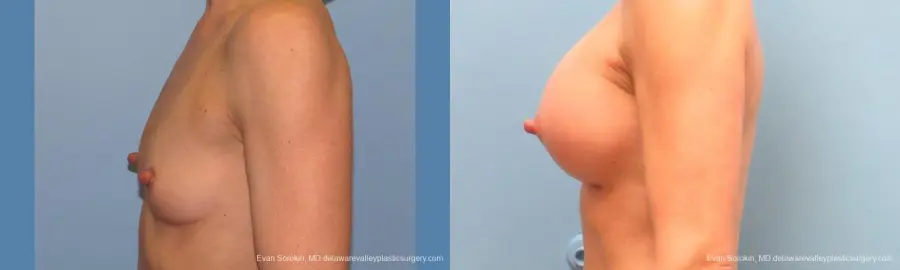 Philadelphia Breast Augmentation 9744 - Before and After 5
