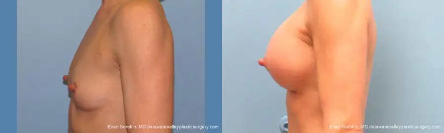 Philadelphia Breast Augmentation 9744 - Before and After 5