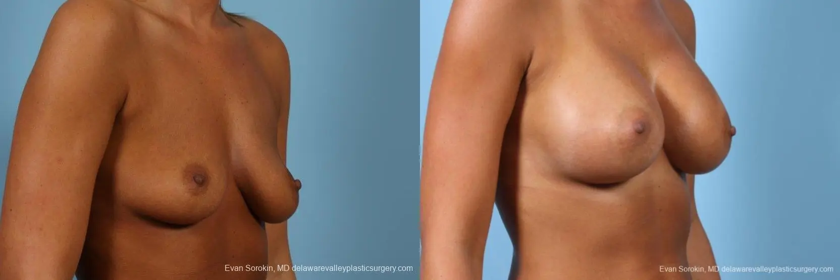 Philadelphia Breast Augmentation 9404 - Before and After 2