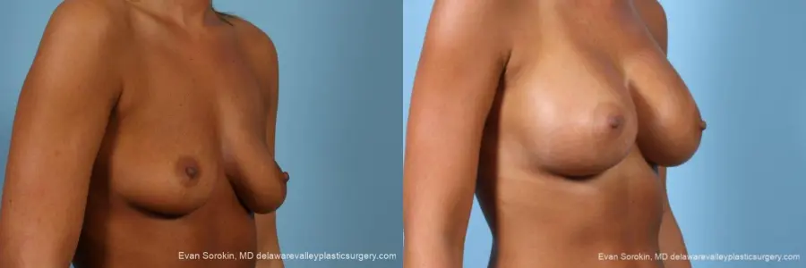 Philadelphia Breast Augmentation 9404 - Before and After 2