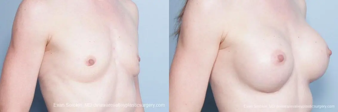 Philadelphia Breast Augmentation 9169 - Before and After 2