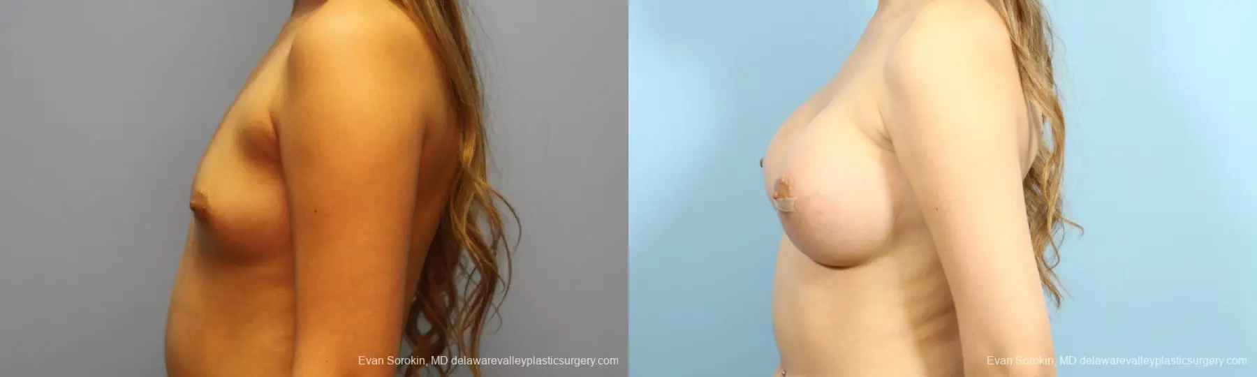 Philadelphia Breast Augmentation 9194 - Before and After 5