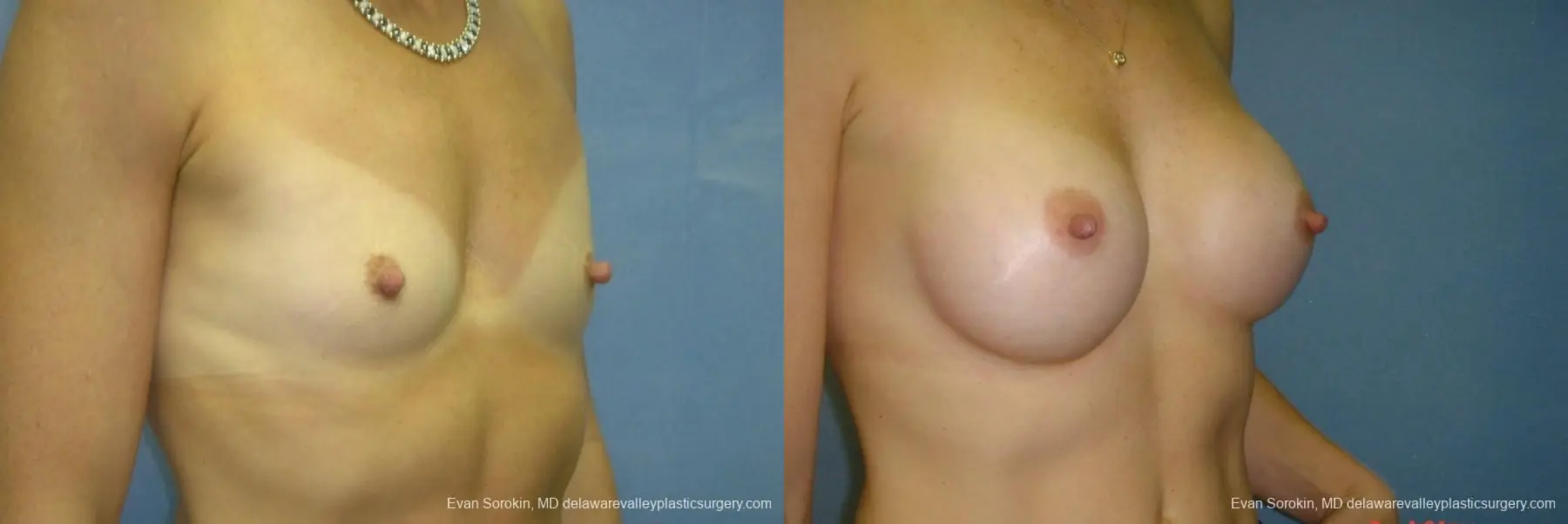 Breast Augmentation 8667 - Before and After 2