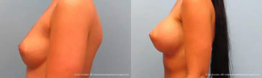 Breast Augmentation: Patient 11 - Before and After 5