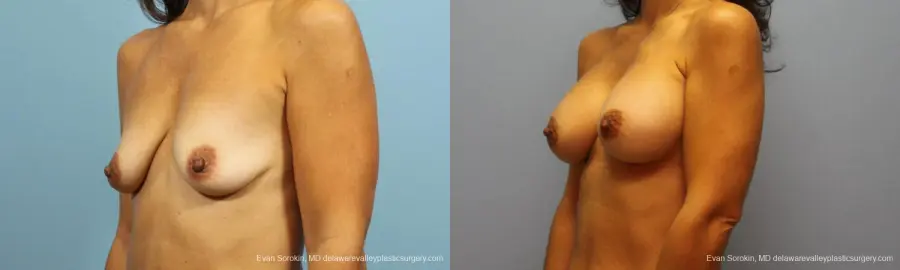 Philadelphia Breast Augmentation 9422 - Before and After 4