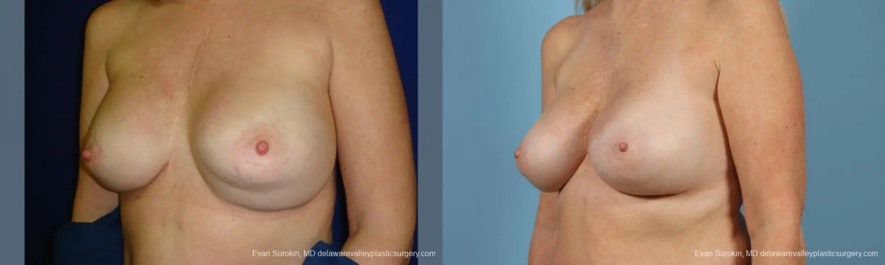 Philadelphia Breast Augmentation 9457 - Before and After 2
