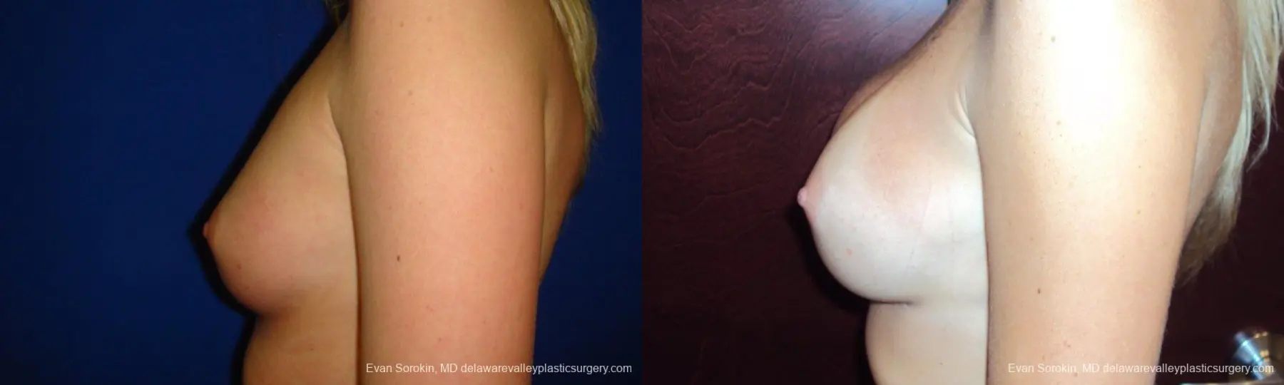 Philadelphia Breast Augmentation 9293 - Before and After 5