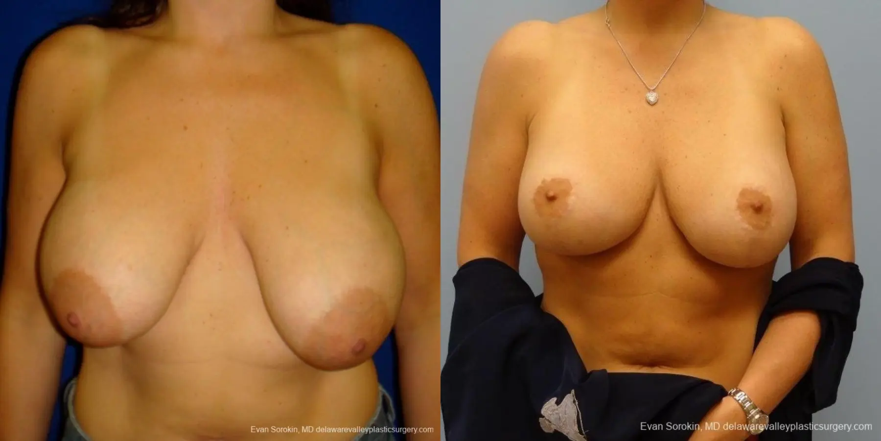 Philadelphia Breast Augmentation 8695 - Before and After 1