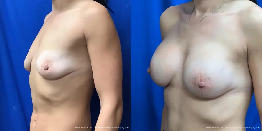 Breast Augmentation: Patient 227 - Before and After 3