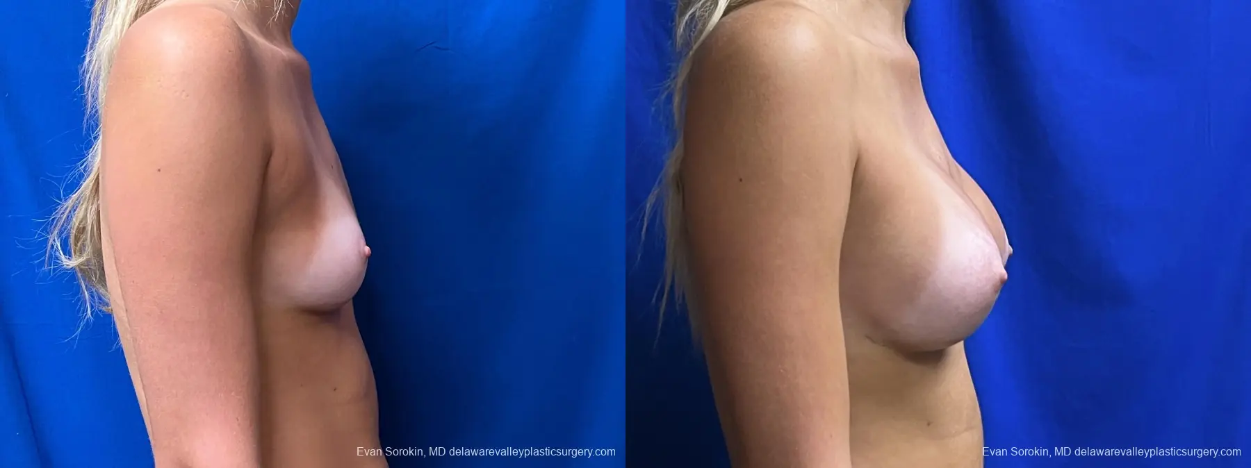 Breast Augmentation: Patient 254 - Before and After 3