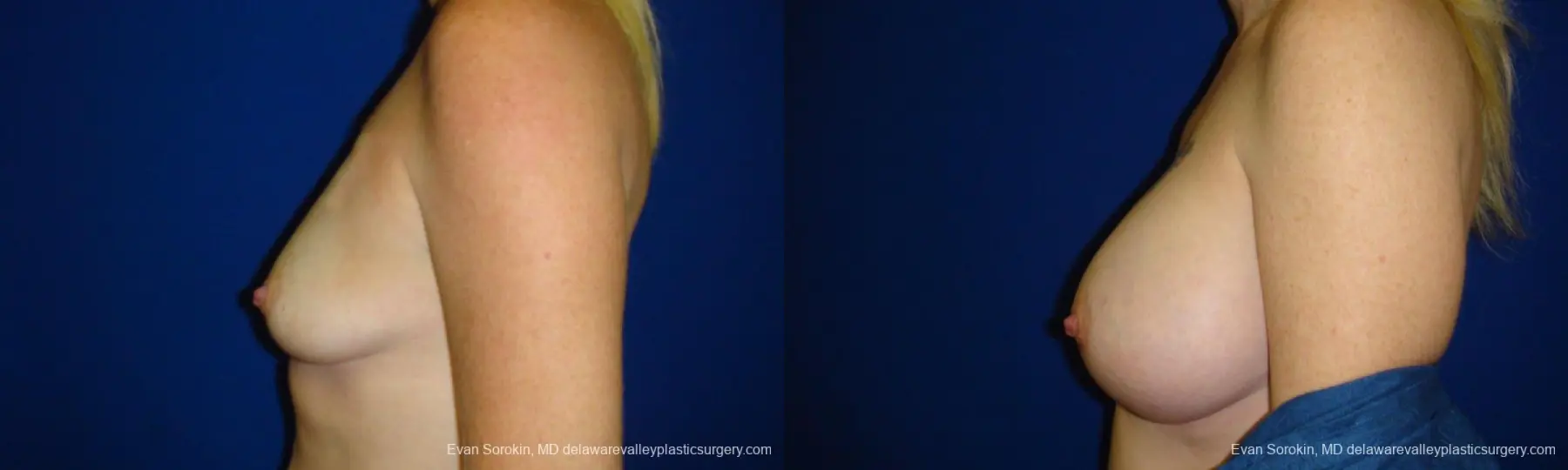 Philadelphia Breast Augmentation 9295 - Before and After 5