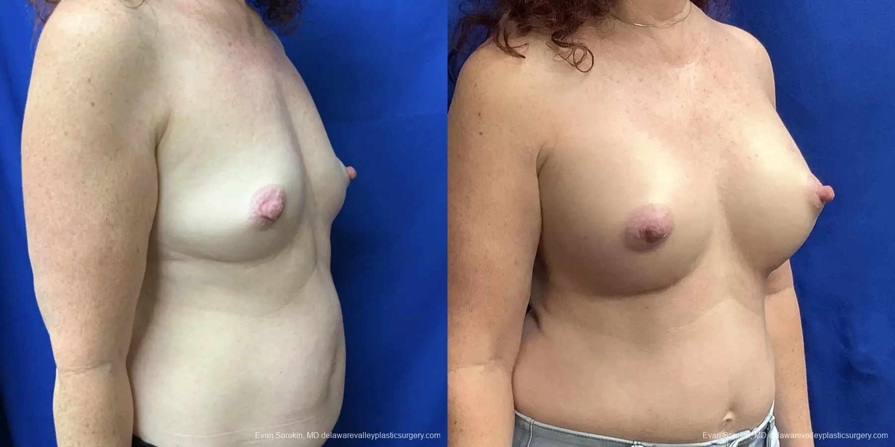 Breast Augmentation: Patient 176 - Before and After 2