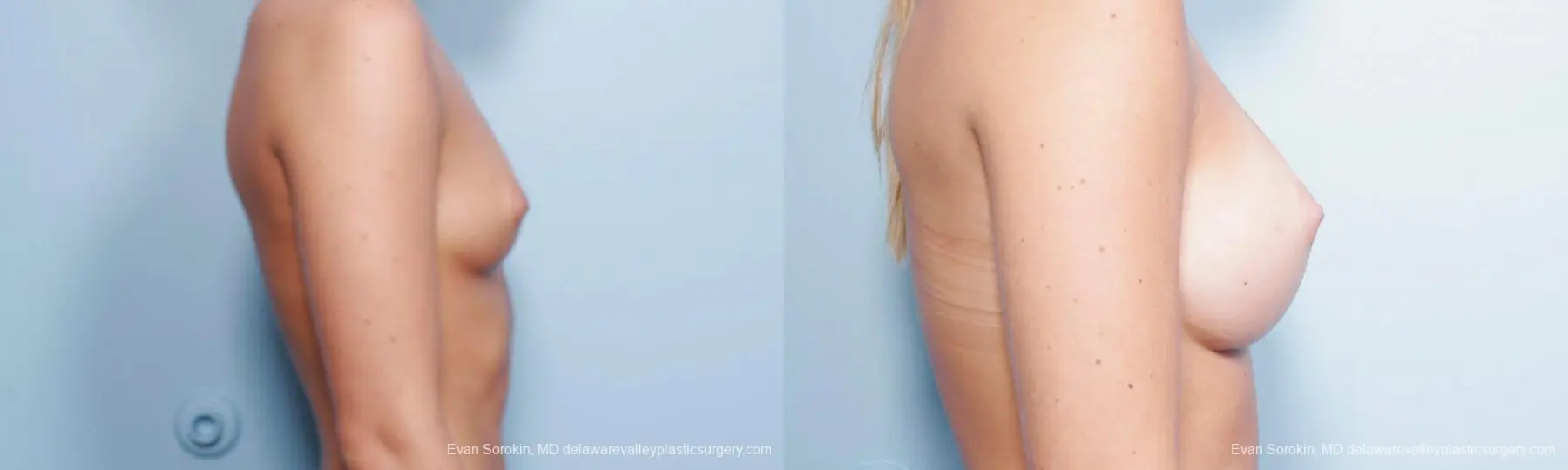 Philadelphia Breast Augmentation 9423 - Before and After 3