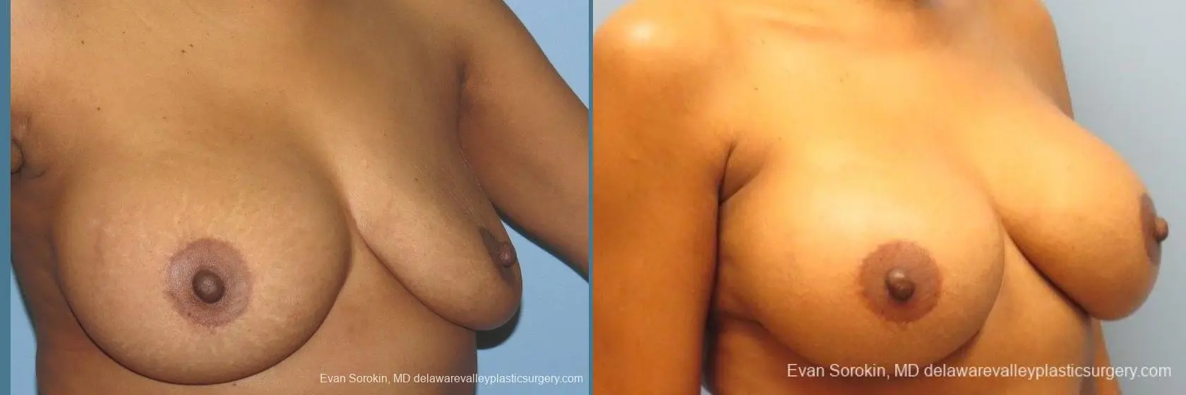 Philadelphia Breast Augmentation 10112 - Before and After 4