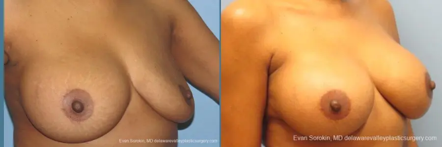 Philadelphia Breast Augmentation 10112 - Before and After 4