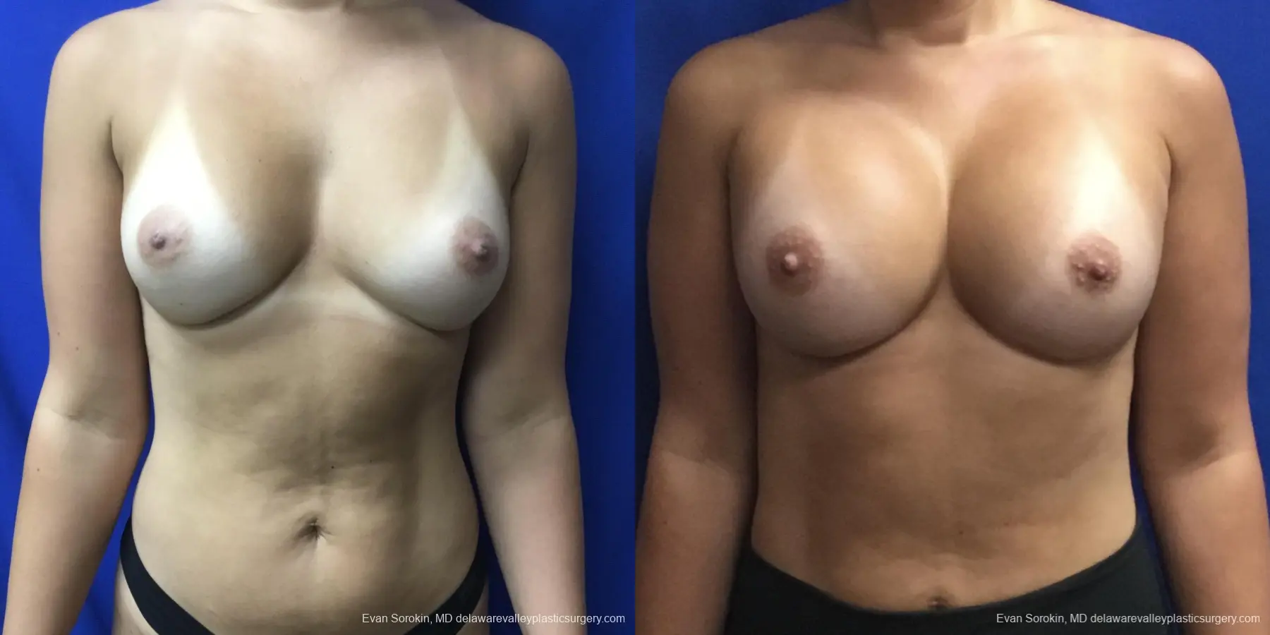 Breast Augmentation: Patient 206 - Before and After 1